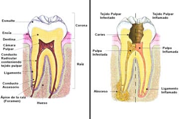 Tecnología utilizada en un tratamiento de endodoncia
