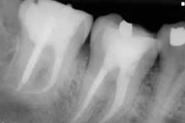 Imagen clínica de Endodoncia