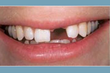 Imagen clínica de Implantología estética