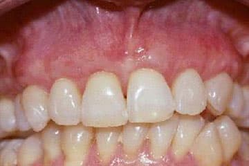 Resultado clínico de un tratamiento periodontal