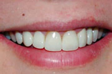 Resultado de una restauración mediante prótesis dental
