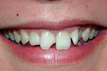 Imagen clínica de Prótesis dentales