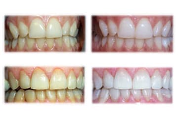 Tratamiento profesional de blanqueamiento dental